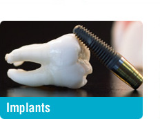 Dental Implants - Toronto Yonge Lawrence